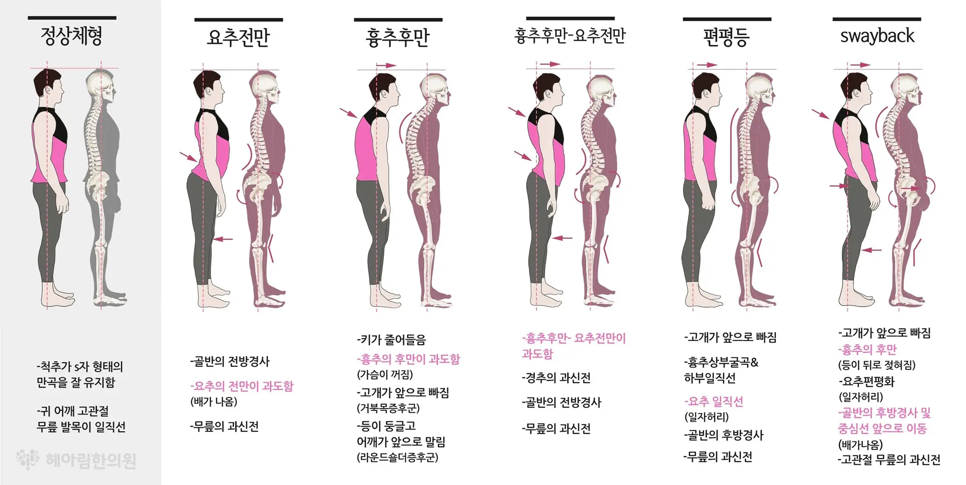 만성통증 원인 치료 - 나쁜 자세 (또는 손상)