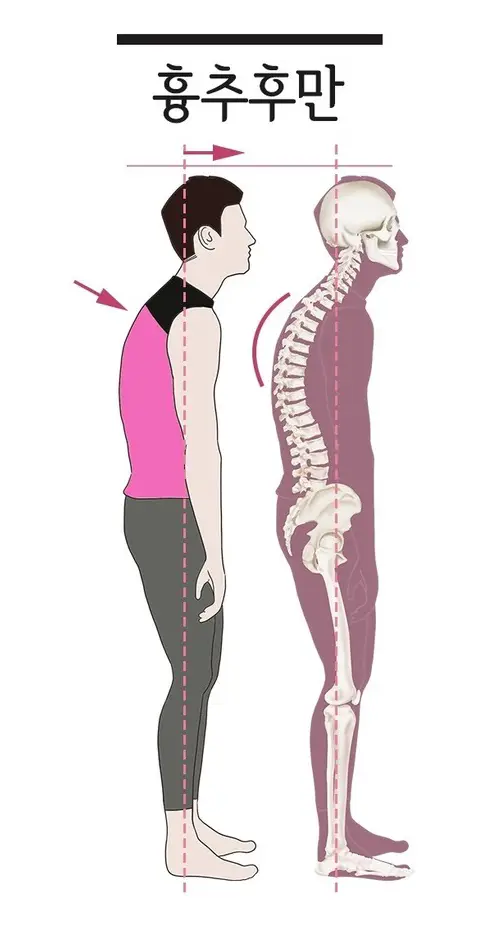 만성통증 원인 치료 - 나쁜 자세 (또는 손상) 5