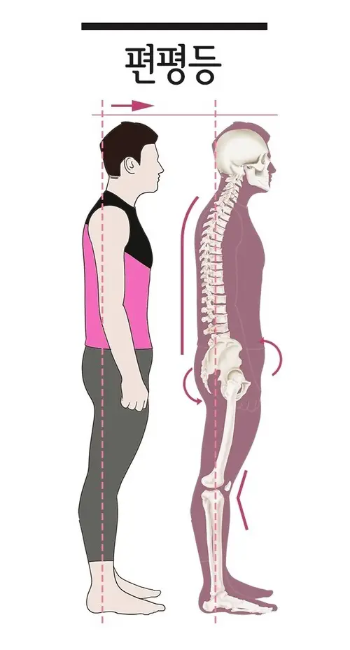 만성통증 원인 치료 - 나쁜 자세 (또는 손상) 7