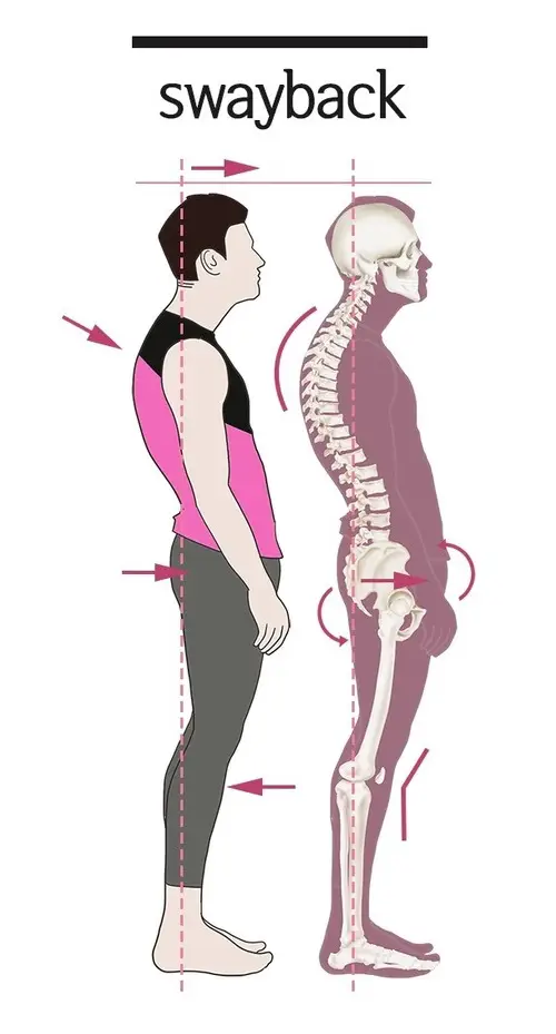 만성통증 원인 치료 - 나쁜 자세 (또는 손상) 8