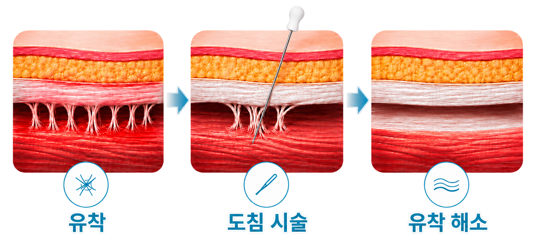 만성통증 원인 치료 - 도침시술 유착 해소 과정 2